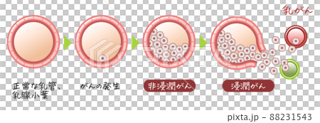 乳がん・乳癌・乳ガン・Breast cancer・浸潤がん・非浸潤がんのイラスト 乳がん・乳癌・乳ガン・Breast cancer・浸潤がん・非浸潤がんのイラスト 88231543
