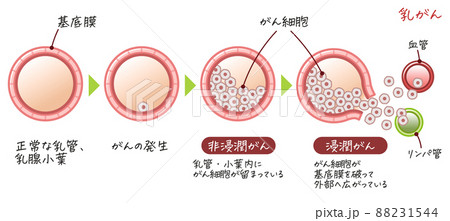 乳がん・乳癌・乳ガン・Breast cancer・浸潤がん・非浸潤がんのイラスト 88231544