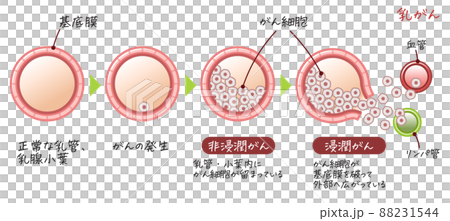 乳がん・乳癌・乳ガン・Breast cancer・浸潤がん・非浸潤がんのイラスト 88231544