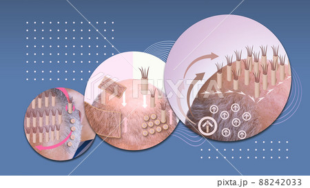 Methods of hair transplantation fut vs fue with infographic elements of illustration. Methods of hair transplantation fut vs fue with infographic elements of illustration. 88242033