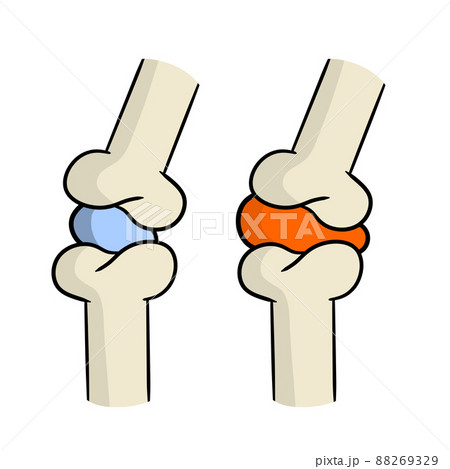 Arthritis. Disease of joints. Arthritis. Disease of joints. 88269329