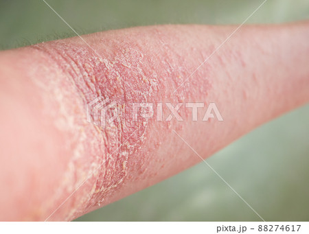 Close-up view of the eczema on a person's arm. 88274617