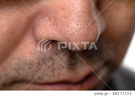 小鼻の汚れ　毛穴の黒ずみ　角栓物質 88277155