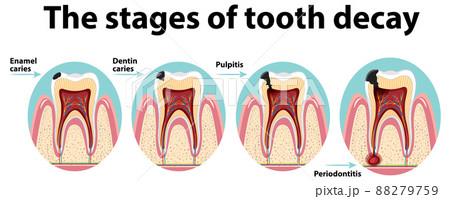 Infographic of human in the stages of tooth decay Infographic of human in the stages of tooth decay 88279759