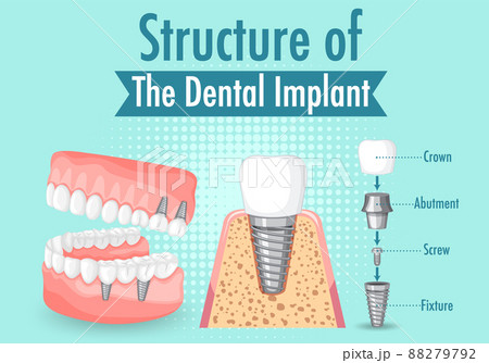 Infographic of human in structure of the dental implant 88279792