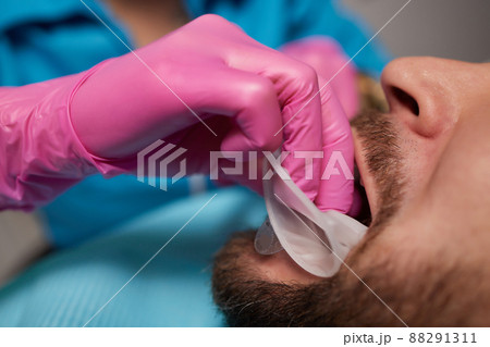 Closeup of man's teeth with retractor for mouth. Patient at the dentist .Tooth disease. Severe rot, carious, tooth loss. Before the treatments. 88291311