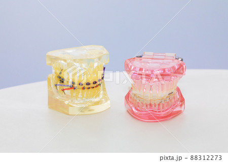 歯列矯正の歯形模型 88312273