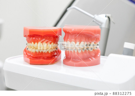 歯科医院にある矯正装置の歯列模型 88312275