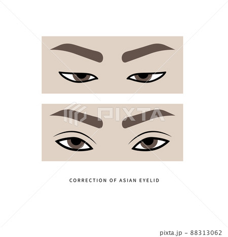 Plastic surgery for formation of upper eyelid 88313062