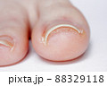 巻き爪の女性の足の指先 88329118