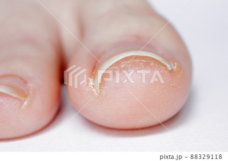 巻き爪の女性の足の指先 88329118