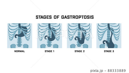 Stages of gastroptosis. Dropped stomach. Shapes and positions of the stomach Stages of gastroptosis. Dropped stomach. Shapes and positions of the stomach 88333889
