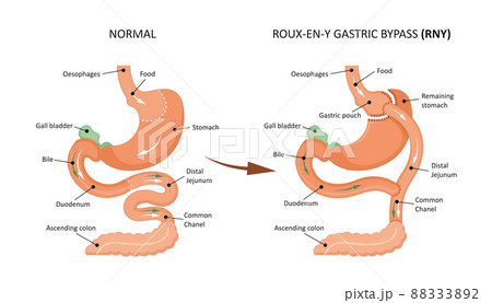 Roux-en-y gastric bypass (RNY). Showing a gastric pouch and gastrojejunal anastomosis. Roux-en-y gastric bypass (RNY). Showing a gastric pouch and gastrojejunal anastomosis. 88333892