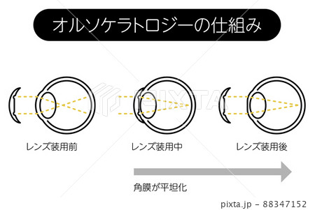 視力矯正レンズ、オルソケラトロジーレンズの仕組み 88347152