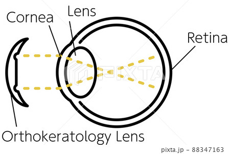 視力矯正レンズ、オルソケラトロジーレンズの図解(装用前) 視力矯正レンズ、オルソケラトロジーレンズの図解(装用前) 88347163