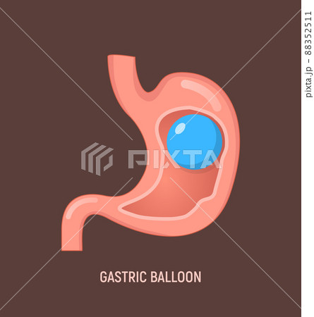 Gastric balloon weight loss intragastric surgery. Stomach gastric balloon operation vector icon Gastric balloon weight loss intragastric surgery. Stomach gastric balloon operation vector icon 88352511