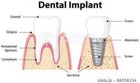Infographic of human in structure of the dental implant 88356154