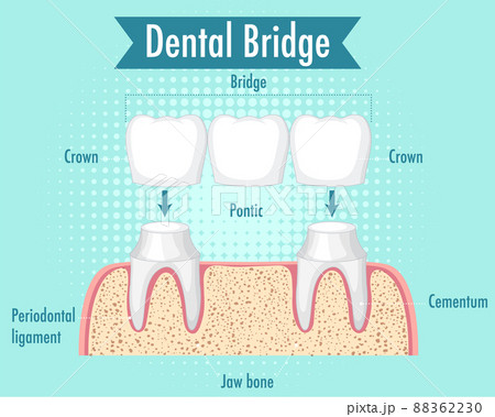 Infographic of human in dental bridge 88362230