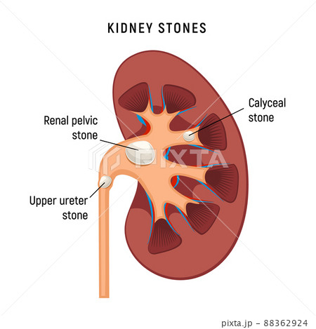 Kidney cartoon stones disease vector infographic. Urinary renal kidnay stone surgey background Kidney cartoon stones disease vector infographic. Urinary renal kidnay stone surgey background 88362924