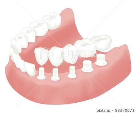 インブラント インブラント 88370073