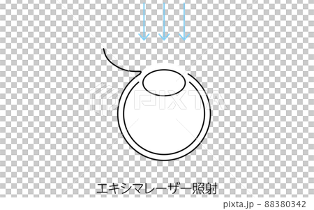 LASIK, Medical Illustration of Refractive Surgery 88380342