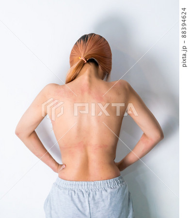 Woman with Skin allergy all over her body showing her back part with red rash and skin infection. Woman with Skin allergy all over her body showing her back part with red rash and skin infection. 88394624
