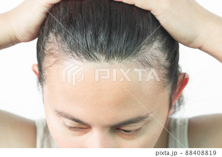 Woman serious hair loss problem for health care shampoo and beauty product concept, selective focus Woman serious hair loss problem for health care shampoo and beauty product concept, selective focus 88408819