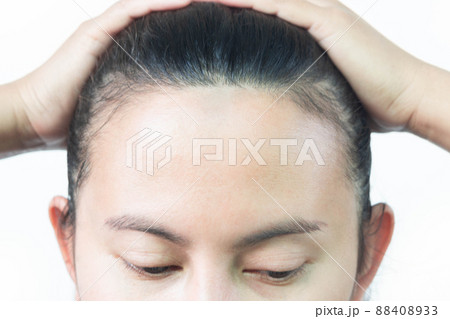 Woman serious hair loss problem for health care shampoo and beauty product concept, selective focus 88408933