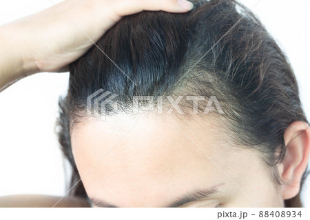 Woman serious hair loss problem for health care shampoo and beauty product concept, selective focus 88408934