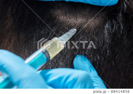 Injection plasma into head hair man cosmetologist doctor. 88414856