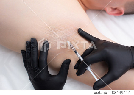 Closeup of a doctor hands in medical gloves with a syringe performs botox injections into the armpit for a young man to prevent excessive sweating Closeup of a doctor hands in medical gloves with a syringe performs botox injections into the armpit for a young man to prevent excessive sweating 88449414