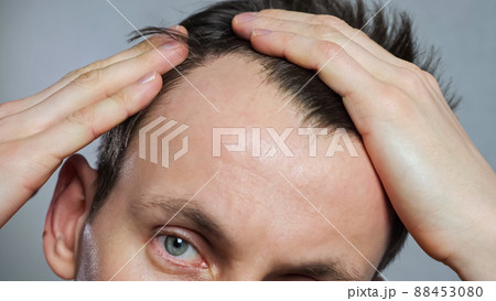 Young man with bald spots suffering from hair loss, 88453080