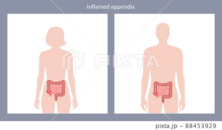 Appendix pain concept 88453929