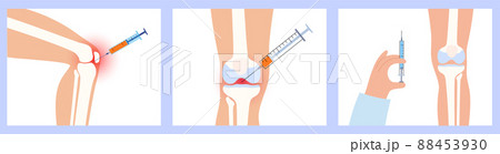 Knee Injection procedure 88453930