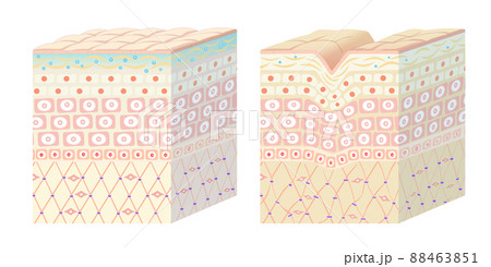 健康な肌とシワができた肌の断面図 88463851