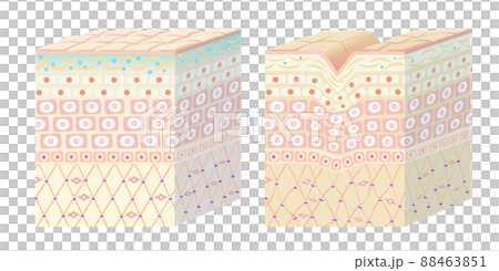 健康な肌とシワができた肌の断面図 88463851