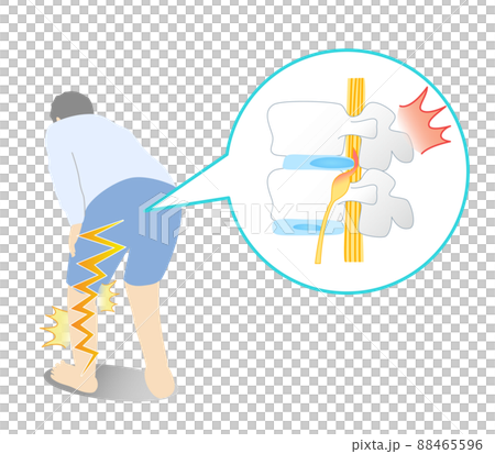 Illustrated illustration of a person with a lumbar disc hernia that hurts his leg 88465596