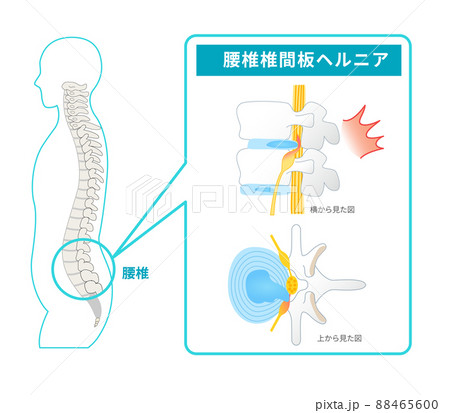 腰椎椎間板ヘルニアの図解イラスト 腰椎椎間板ヘルニアの図解イラスト 88465600