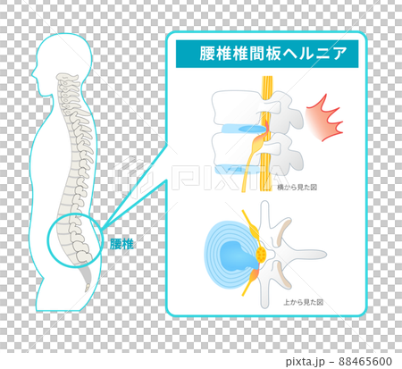腰椎椎間板ヘルニアの図解イラスト 腰椎椎間板ヘルニアの図解イラスト 88465600