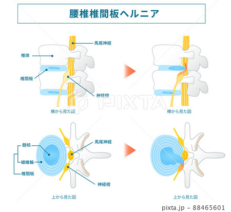 腰椎椎間板ヘルニアの図解イラスト 88465601