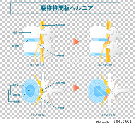 腰椎椎間板ヘルニアの図解イラスト 88465601