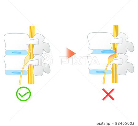 腰椎椎間板ヘルニアの図解イラスト 88465602