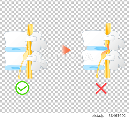 腰椎椎間板ヘルニアの図解イラスト 88465602
