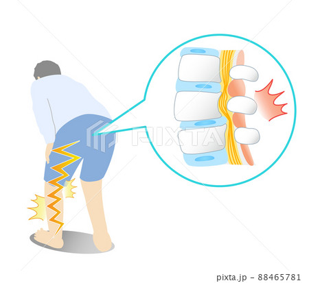 腰部脊柱管狭窄症で足が痛い人の図解イラスト 88465781