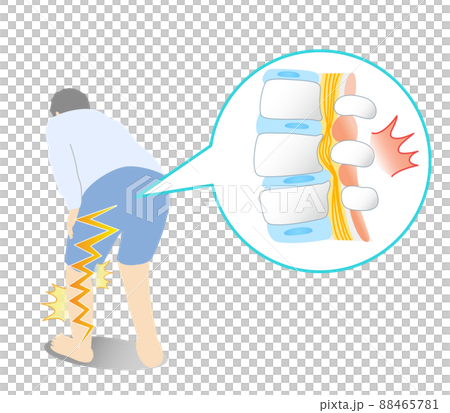 腰部脊柱管狭窄症で足が痛い人の図解イラスト 88465781