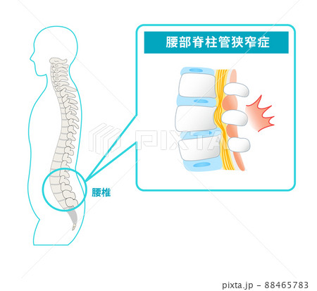 腰部脊柱管狭窄症の図解イラスト 腰部脊柱管狭窄症の図解イラスト 88465783