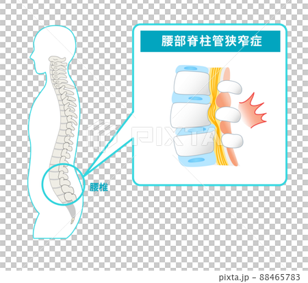 腰部脊柱管狭窄症の図解イラスト 腰部脊柱管狭窄症の図解イラスト 88465783