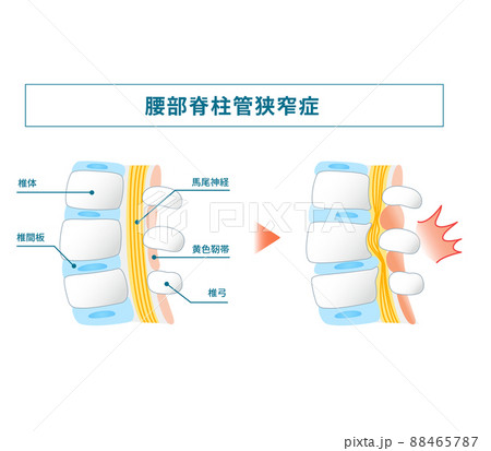 腰部脊柱管狭窄症の図解イラスト 88465787