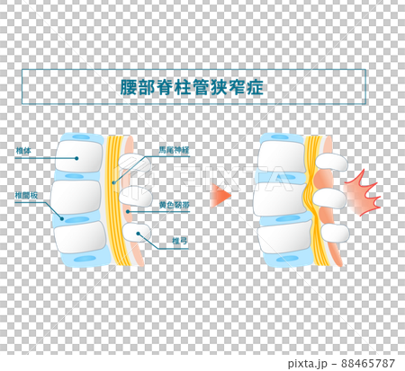 腰部脊柱管狭窄症の図解イラスト 88465787