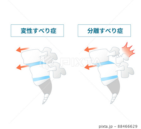 脊椎すべり症の図解イラスト 88466629